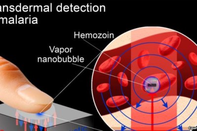 A possible rapid, non-invasive test for malaria infection detects tiny vapour nanobubbles produced by the malaria parasite when it is zapped by a short laser pulse.