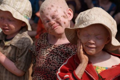 Enfants albinos