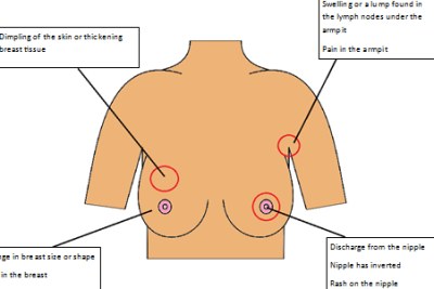 When checking your breasts there are a number of signs and symptoms to look for...
