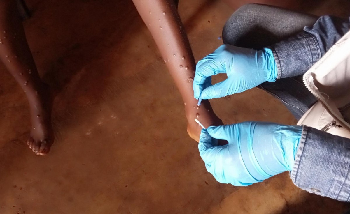 Zambia: Zimbabwe Experiences First Two Mpox Cases, After Zambia Week Prior to thumbnail